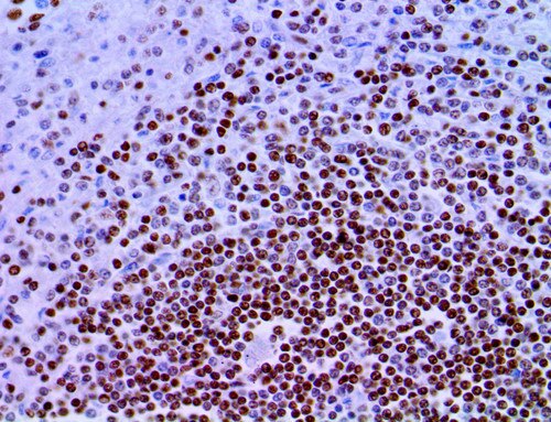 IHC of FOXO1 on an FFPE Lymphoblastic Lymphoma Tissue